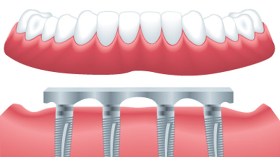 Implant Supported Dentures Springfield, MO