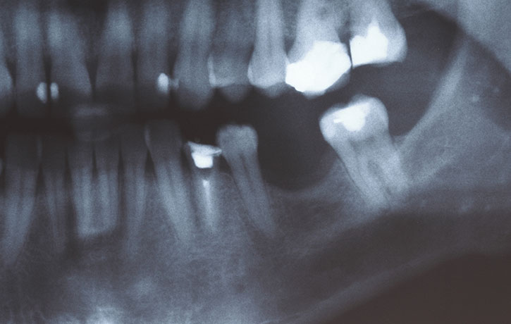Bone Grafting Springfield, MO