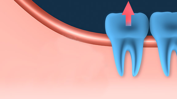 Tooth Extractions Springfield, MO