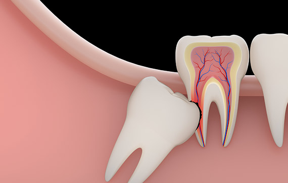 Tooth Extractions Springfield, MO