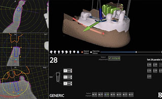 Benefits of Dental Implants Springfield, MO